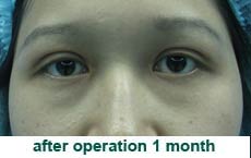 plastic-surgery-blepharoplasty